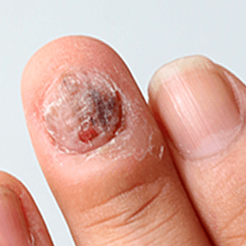 Zu Schuppenflechte am Nagel: Was hilft bei Nagelpsoriasis?